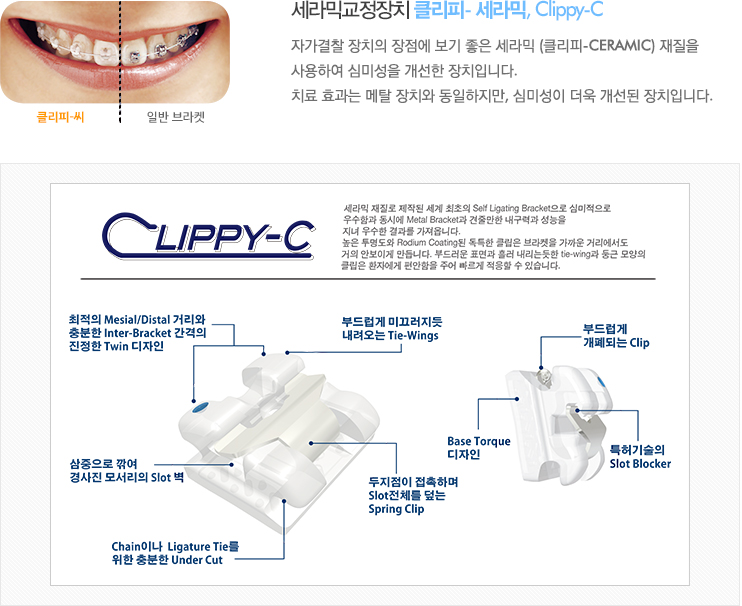 세라믹교정장치 클리피- 세라믹, Clippy-C 자가결찰 장치의 장점에 보기 좋은 세라믹 (클리피-Ceramic) 재질을 사용하여 심미성을 개선한 장치입니다. 
치료 효과는 메탈 장치와 동일하지만, 심미성이 더욱 개선된 장치입니다. 