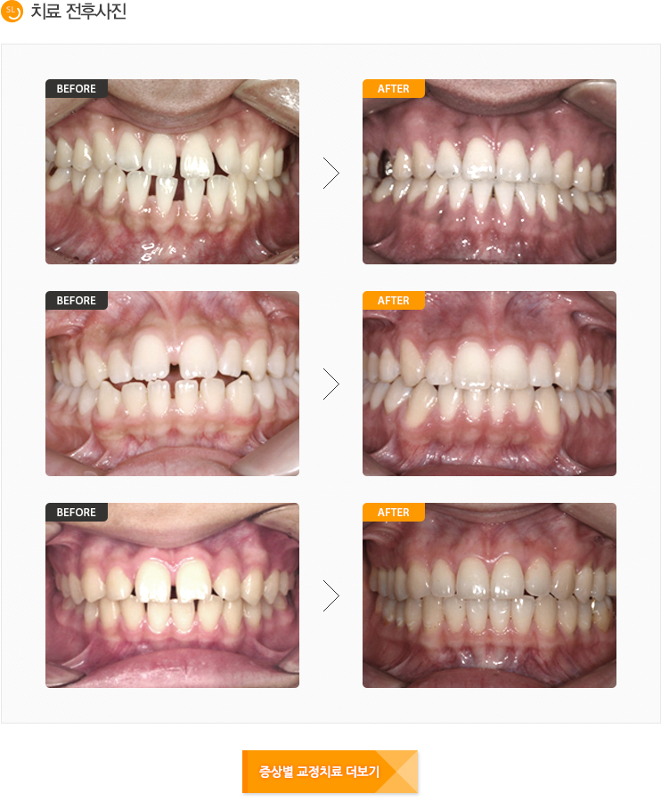 벌어진치아 전후사진입니다