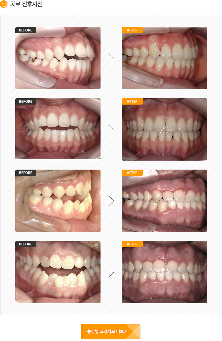 개방교합 전후사진입니다